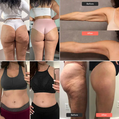 15-Day Fast-Acting Anti Cellulite  Sculpting & Tightening