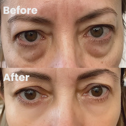 LiftEyes™ Pro