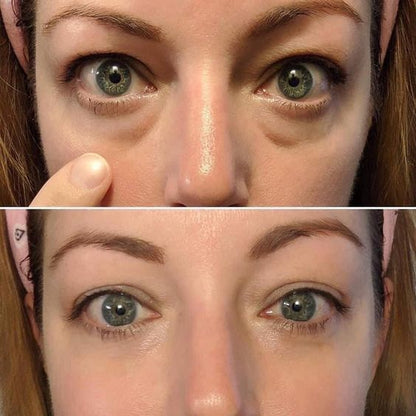 LiftEyes™ Pro