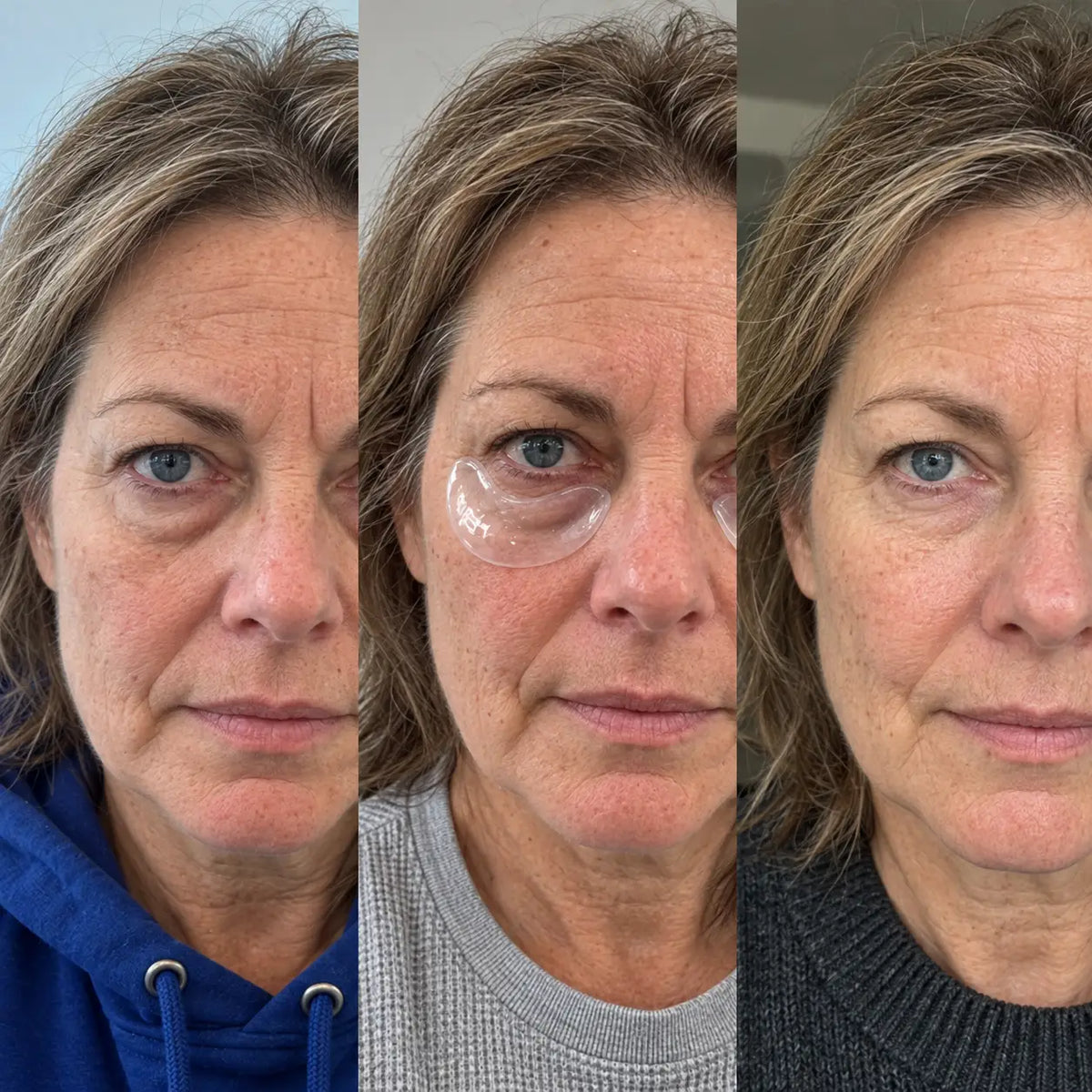 CEBEAM™ Microneedle Under-Eye Patches